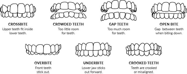 Invisalign Treatable Cases | Windsor Dentist | The Avenue Dental Centre